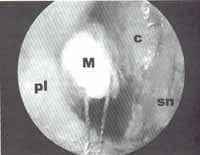 Lámina expansible de Merocel Lámina expansible de Merocel