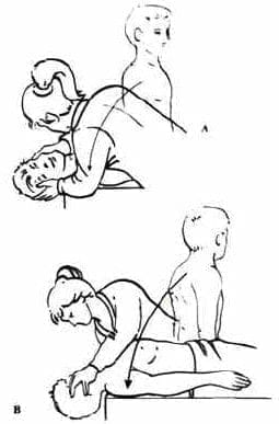 Test de Dix-Hallpike Test de Dix-Hallpike