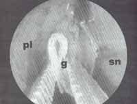 Lámina rígida de Silastic Lámina rígida de Silastic
