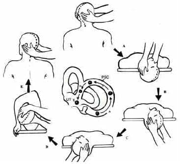 Maniobra de reposición canalicular