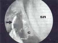 Cornete medio inestable  Cornete medio inestable