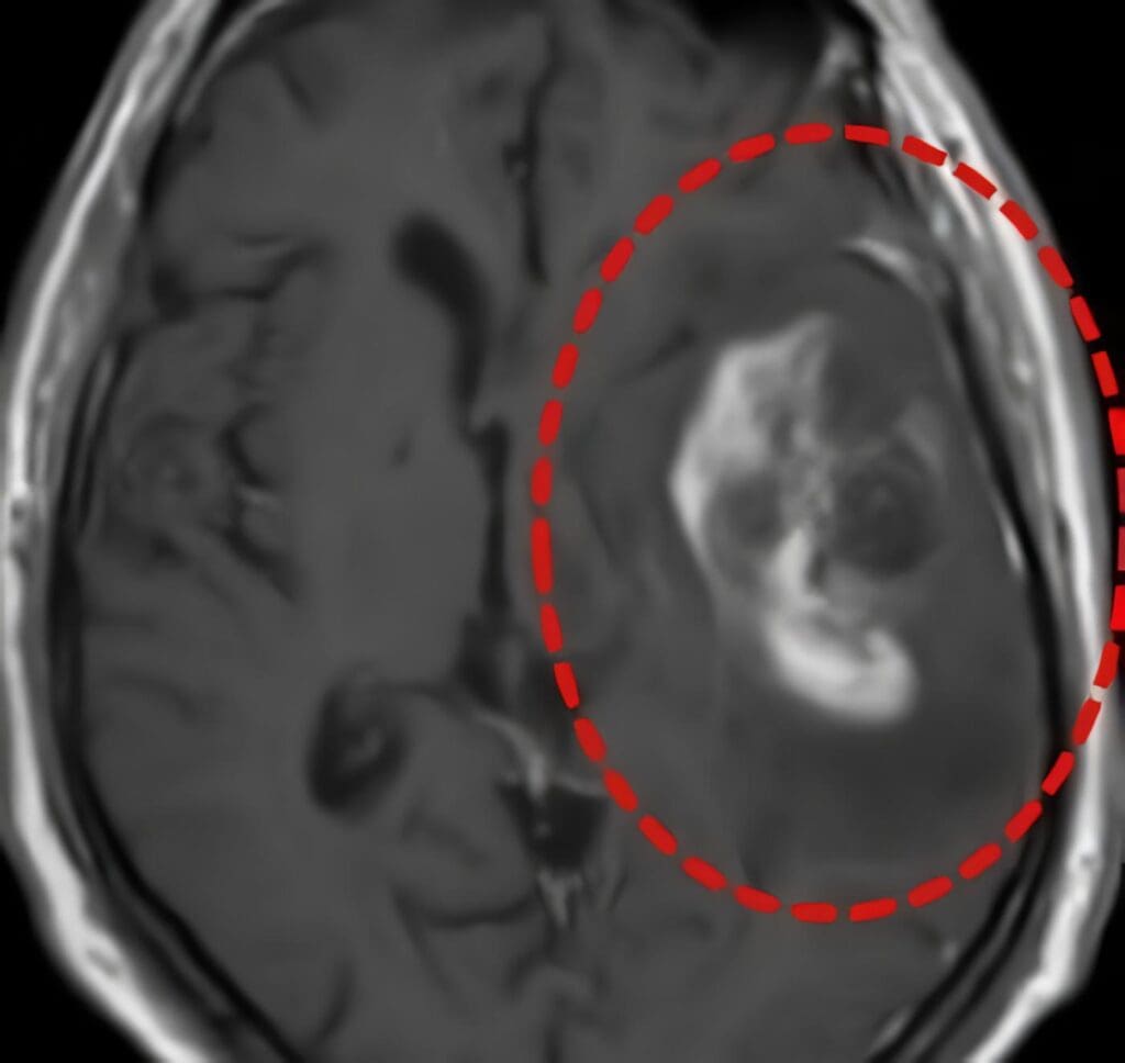 Pacientes con Gliobastoma Multiforme