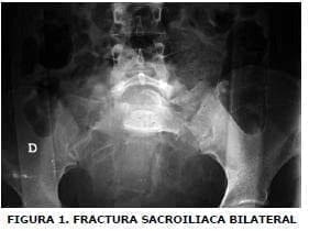 Fractura sacroiliaca bilateral Fractura sacroiliaca bilateral
