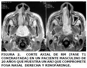 Corte axial de RM fase T1 Corte axial de RM fase T1