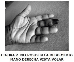 Necrosis seca dedo medio mano