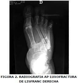 Radiografía AP luxofractura Radiografía AP luxofractura