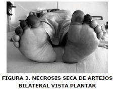 Necrosis seca de artejos