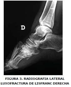 Radiografía lateral Luxofractura Radiografía lateral Luxofractura
