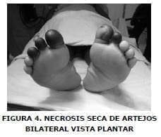 Anemia de Células Falciformes, Necrosis seca de artejos