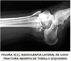 Radiografía lateral de luxofractura Radiografía lateral de luxofractura