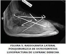 Radiografía lateral de Osteosintesis Luxofractura Radiografía lateral de Osteosintesis Luxofractura