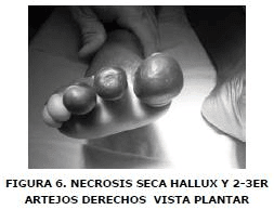 Necrosis seca Hallux y 2-3er