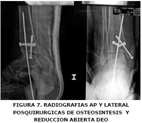Radiografía AP y lateral Radiografía AP y lateral