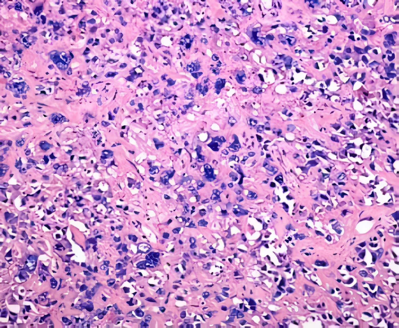 Glioblastoma Multiforme