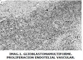 Glioblastoma multiforme Glioblastoma multiforme