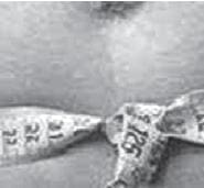 Obesidad abdominal Obesidad abdominal