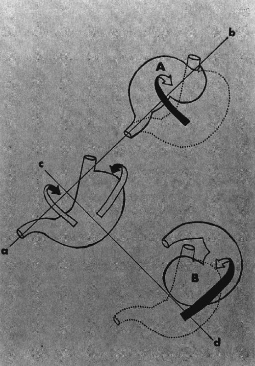 Esquema  vólvulo organoaxial 