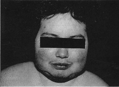 Alteración de la facies y de los depósitos grasos supraclaviculares  Alteración de la facies y de los depósitos grasos supraclaviculares