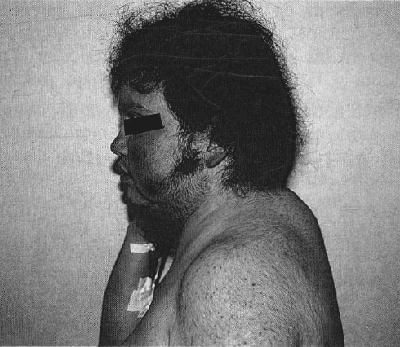 Alteración de los depósitos de grasa Alteración de los depósitos de grasa