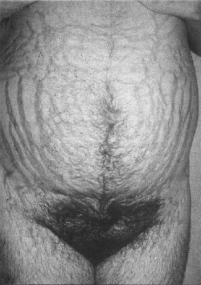 las estrías en el síndrome de Cushing las estrías en el síndrome de Cushing