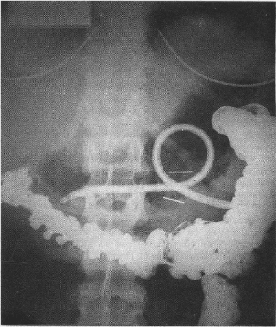 Sonda de gastrostomía