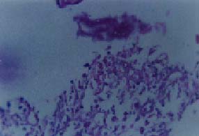 Area necrótica de la mucosa Area necrótica de la mucosa