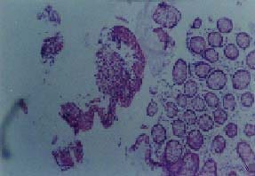 Epitelio colónico ulcerado Epitelio colónico ulcerado