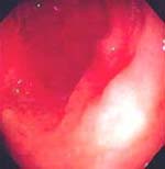 Carcinoma gástrico temprano antral Carcinoma gástrico temprano antral