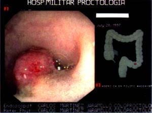 Pólipo maligno Pólipo maligno
