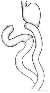 Gastro yeyunostomía en Y de Roux Gastro yeyunostomía en Y de Roux