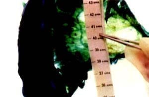 Recto sigmoide Recto sigmoide