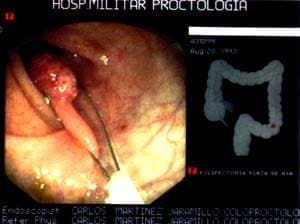 Asa de polipectomía, Pólipo Colorrectal Maligno Asa de polipectomía, Pólipo Colorrectal Maligno