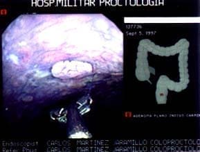 Pólipo plano Pólipo plano