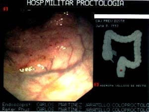 Pólipo de extensión lateral Pólipo de extensión lateral