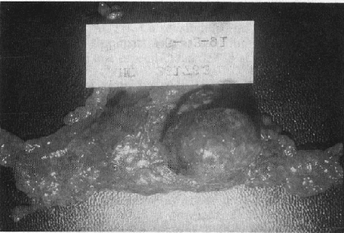 Glándula adrenal extirpada con un adenoma