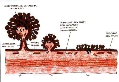 Diferentes formas de pólipos, Pólipo Colorrectal Maligno