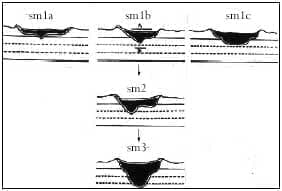 Invasión cáncer colorrectal temprano Invasión cáncer colorrectal temprano