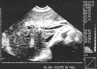 Ecografía hepática que muestra un parásitoen el colédoco (flechas). Ecografía hepática que muestra un parásitoen el colédoco (flechas).