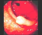Carcinoma gástrico temprano antral tipo IIa Carcinoma gástrico temprano antral tipo IIa