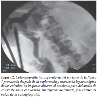 Exploración y extracción laparoscópica de cálculos