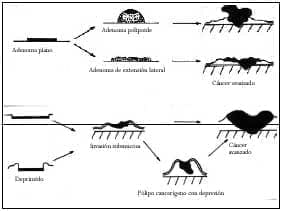 Adenomas planos y lesiones deprimidas según Kudo