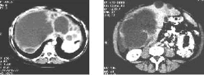 TAC abdominal que muestra quiste complejo en el lóbulo derecho del hígado.