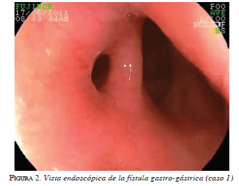 Vista endoscópica de la fistula gastro-gàstrica figura2-vista-endoscopica