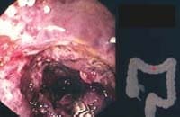 Hematoma submucoso  Hematoma submucoso