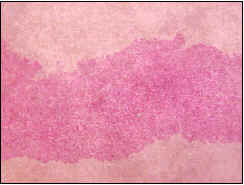 Colestasis intrahepática