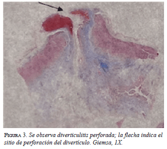 Diverticulitis-Perforada figura3-diverticulitis-perforada
