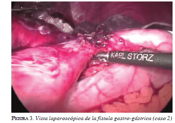 Vista laparoscópica de la fistula gastro-gàstrica figura3-vista-laparoscopica