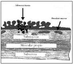Lesiones sésiles según Haggit, Cáncer Colorrectal Lesiones sésiles según Haggit, Cáncer Colorrectal