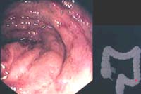 Mucosa pálida, membranas grisácesas Mucosa pálida, membranas grisácesas