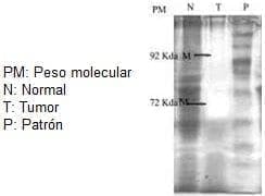 Caso de cáncer gástrico Caso de cáncer gástrico